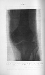 Fig. 5. Radiographie de notre observation III. (Fracture du condyle interne du tibia) - Exposé des t [...]