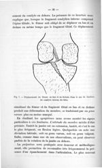 Fig. 7. Déplacement du fémur en bas et en dedans dans le cas de fracture du condyle interne du tibia [...]