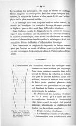 Fig. 15. Tracé de l'incision pour l'arthrotomie dans la luxation du cartilage semi-lunaire interne - [...]