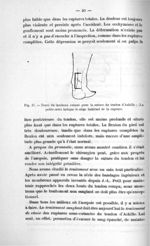 Fig. 17. Tracé du lambeau cutané pour la suture du tendon d'Achille ; (La petite croix indique le si [...]