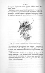 Fig. 19. Estomac et duodénum ouvert. (On voit l'ulcère duodénal) - Exposé des titres & travaux scien [...]