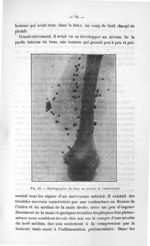 Fig. 22. Radiographie du bras au niveau de l'anévrysme - Exposé des titres & travaux scientifiques