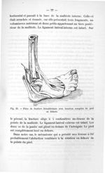 Fig. 23. Pièce de fracture bimalléolaire avec luxation complète du pied en dehors - Exposé des titre [...]