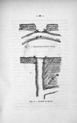 Fig. 1. Jéjunostomie latérale simple / Fig. 2. Procédé du Maydl - Exposé des titres & travaux scient [...]