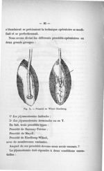 Fig. 3. Procédé de Witzel Eiselberg - Exposé des titres & travaux scientifiques. Avril 1907