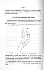 Fig. 7. 5e doigt et 6e doigt sur un métatarsien commun - Concours d'agrégation, section chirurgie et [...]