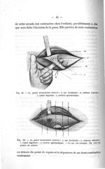 Fig. 11. m, paroi musculaire relevée ; s, sac herniaire ; a, anneau interne ; i, canal inguinal ; c, [...]