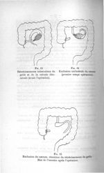 Fig. 13. Rétrécissements tuberculeux du grêle et de la valvule iléocaecal (avant l'opération) / Fig. [...]