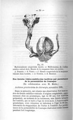 Fig. 19. Hydronéphrose congénitale double - Titres et travaux scientifiques