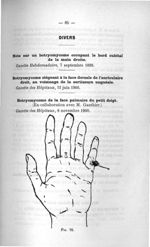 Fig. 26. [Cas de botryomycome de la face palmaire du petit doigt] - Titres et travaux scientifiques