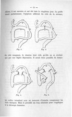 Fig. 3 / 4 / Fig. 5 / Fig. 6 - Concours d'agrégation de chirurgie. Mars 1907. Exposé des titres et t [...]