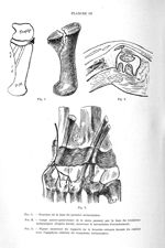 Fig. 1. Fracture de la base du premier métacarpien / Fig. 2. Coupe antéro-postérieure de la main pas [...]