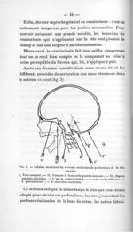 Fig. 2. Schéma montrant les diverses méthodes de perforation de la tête dernière - Titres et travaux [...]
