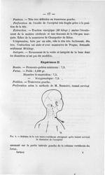 Fig. 5. Schéma de la voie latéro-vertébrale atteignant après tunnel cervical la charnière de l'occip [...]