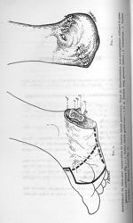 Fig. 1 / Fig. 2. Arrachement du talon avec conservation de l'artère tibiale postérieure - Concours p [...]