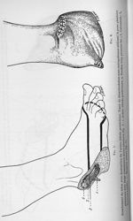 Fig. 5 / Fig. 6. Arrachement du talon avec destruction de l'artère tibiale postérieure - Concours po [...]