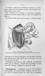 Fig. 6. Résection de l'anse iléo-caecale - Titres et travaux scientifiques