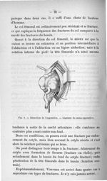 Fig. 8. Résection de l'appendice - Titres et travaux scientifiques