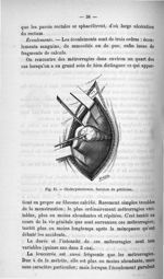Fig. 15. Cholécystectomie. Incision du péritoine - Titres et travaux scientifiques