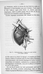 Fig. 17. Cholécystectomie. - Ligature du canal cystique et de l'artère cystique - Titres et travaux  [...]