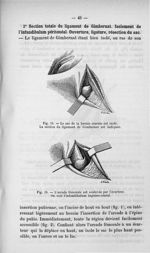 Fig. 18. Le sac de la hernie crurale est isolé. La section du ligament de Gimbernat est indiquée / F [...]