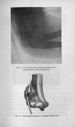 Fig. 3. Fracture sus-condylienne transversale. Radiographie antéro-postérieure / Fig. 4. Nerf radial [...]