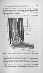 Fig. 6. Figure schématique montrant le nouveau trajet du radial suturé - Titres et travaux scientifi [...]