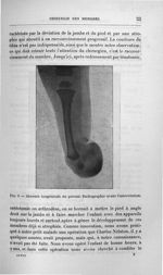 Fig. 9. Absence congénitale du péroné. Radiographie avant l'intervention - Titres et travaux scienti [...]
