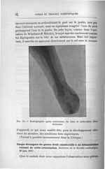 Fig. 10. Radiographie après ostéotomie du tibia et arthrodèse tibiotarsienne - Titres et travaux sci [...]