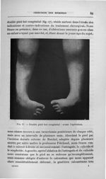 FIg. 17. Double pied bot congénital: avant l'opération - Titres et travaux scientifiques du Dr Josep [...]