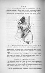 Fig. 5. Pièce expérimentale de luxation du poignet en arrière - Titres et travaux scientifiques
