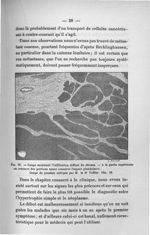 Fig. 15. Coupe montrant l'infiltration diffuse du stroma - Titres et travaux scientifiques