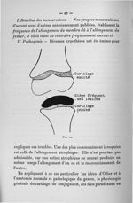 Fig. 10. [Schéma de lésions des cartilages dans les ostéo-arthrites tuberculeuses du genou] - Titres [...]