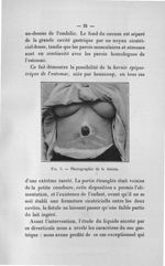 Fig. 5. Photographie de la lésion - Concours pour l'agrégation, 1907, section de pathologie externe  [...]