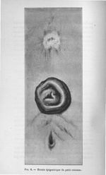 Fig. 6. Hernie épigastrique du petit estomac - Concours pour l'agrégation, 1907, section de patholog [...]