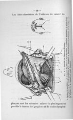 Fig. 8. Procédé de Sedillot-Kocher - Concours pour l'agrégation, 1907, section de pathologie externe [...]