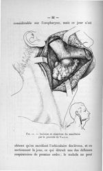 Fig. 11. Incision et résection du maxillaire par le procédé de Vallas - Concours pour l'agrégation,  [...]