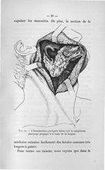 Fig. 12. L'hémisection pratiquée laisse voir le néoplasme pharyngé propagé à la base de la langue -  [...]