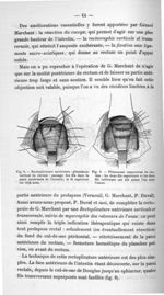 Fig. 8. Rectoplicature antérieure : plissement vertical du rectum / Fig. 9. Plissement transversal d [...]