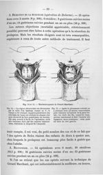 Fig. 14 et 15. Rectococcypexie de Gérard Marchant - Titres et travaux scientifiques