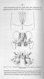Fig. 16, 17 et 18. Rectopexie latérale avec suspension aux ligaments sacro-sciatiques (d'après Ghedi [...]