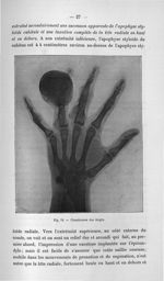 Fig. 19. Chondromes des doigts - Titres et travaux scientifiques