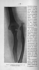 Fig. 20. Squelette de l'avant-bras dans un cas de chondromes des doigts - Titres et travaux scientif [...]