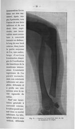 Fig. 21. Squelette de l'avant-bras dans un cas de chondromes des doigts - Titres et travaux scientif [...]