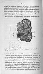 Fig. 22. Chondrome développé sur une exostose ostéogénique (premier cas) : coupe d'ensemble de la tu [...]