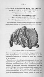Fig. 27. Fragment d'épiploon avec îlots de stéatonécrose - Titres et travaux scientifiques