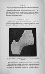 Fig. VII. Synostose de l'articulation de la hanche dans un rhumatisme tuberculeux ankylosant - Conco [...]