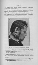Fig. XI. Cancer de la parotide. Extirpation. Guérison - Concours d'agrégation, chirurgie, 1907. Titr [...]
