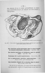 Fig. XIII. Ulcère calleux de la face postérieure de l'estomac pénétrant dans le pancréas et de la pe [...]