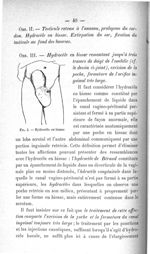 Fig. 2. Hydrocèle en bissac - Concours d'agrégation, de chirurgie et d'accouchements, 1907. Exposé d [...]